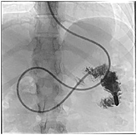 Percutaneous Endoscopic Jejunostomy Tube Placement For Treatment Of