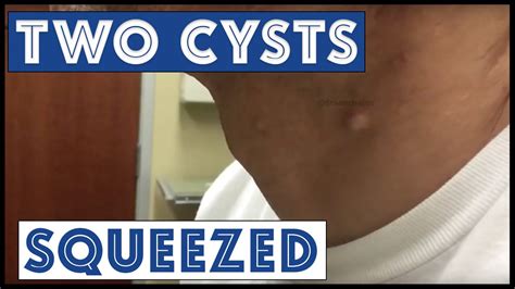 Two Discrete Cysts On The Left Neck Squeezed Youtube