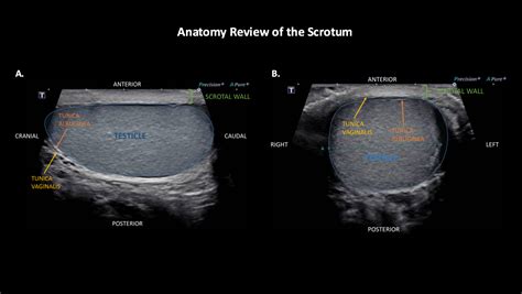 Scrotal Edema Ultrasound