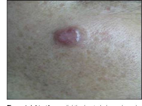 Figure 1 From Primary Mucinous Carcinoma Of The Skin Semantic Scholar