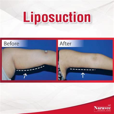 Liposuction Bangkok Naravee Aesthetic Clinic