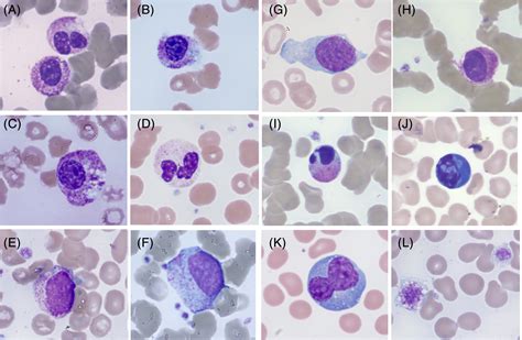 Morphological Anomalies Of Circulating Blood Cells In Covid‐19 Zini