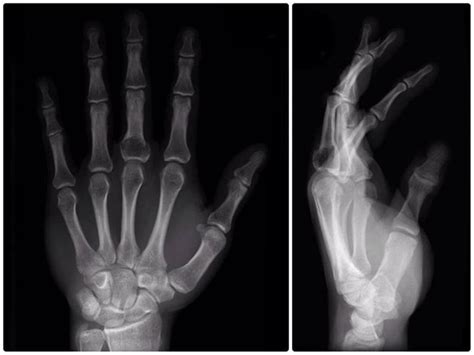 Sudden Middle Finger Pain What Is The Diagnosis