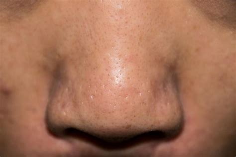 Pores On Nose And How To Clean Them Proven Tips Openpores With