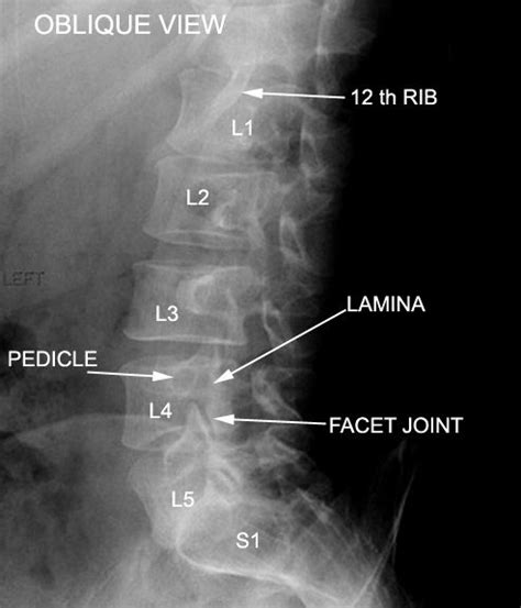The presence of a lumbosacral transitional vertebra alters normal spine biomechanics. Lumbar oblique view | X-Ray: Imaging/Positioning | Pinterest