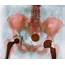 Calcified Uterine Fibroid  Stock Image C039/1647 Science Photo Library