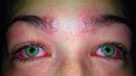 Girl Almost Left Blind After Trying To Tint Her Own Eyebrows