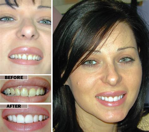 Gum Disease Treatment Brooklyn Nyc Before After