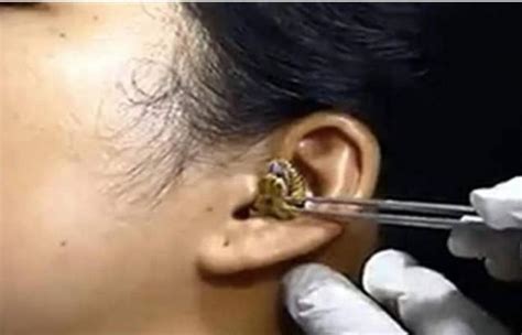 فيديو صادم لحظة استخراج طبيب ثعبان من أذن امرأة
