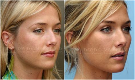 Restylane Cheek Augmentation And Facial Reshaping On The Same Sf 30yo