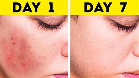 How To Get Rid Of Red Spots On Face After Acne 2021