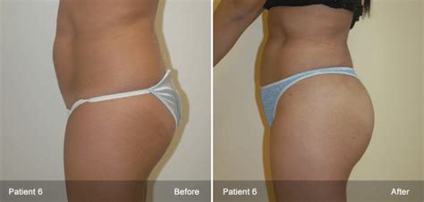 Brazilian Butt Lift Before And After Advisorgasw