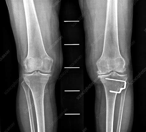 Osteoarthritis Of The Knee X Ray Stock Image C0472742 Science