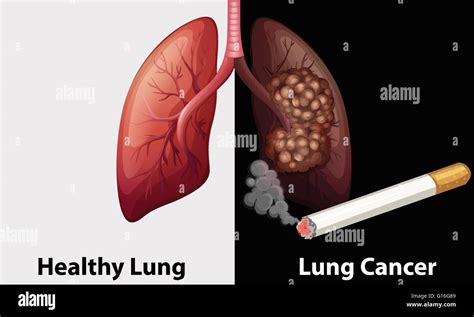 Lung Cancer Pathology Outlines Best Lung Cancer Illustrations Royalty