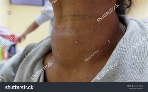 Thyroid Swelling Known Goitre Presented Anterior Stock Photo 1248968896