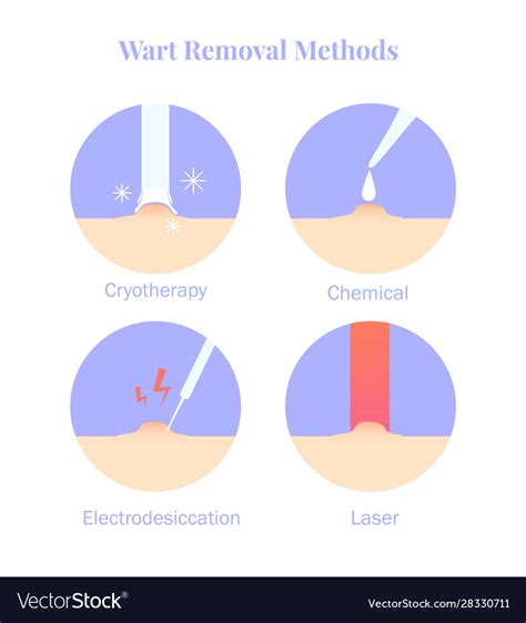 Infographics Wart Removal Methods Cryotherapy Vector Image