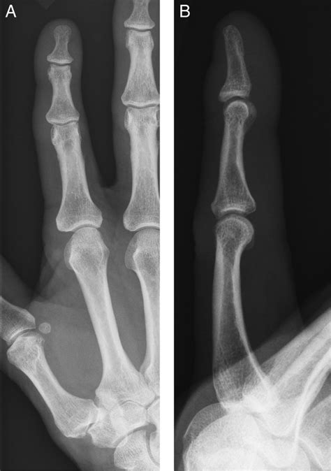 The forces applied to a tendon may be more ruptured tendon causes. Spontaneous flexor tendon rupture in the palm | BMJ Case ...