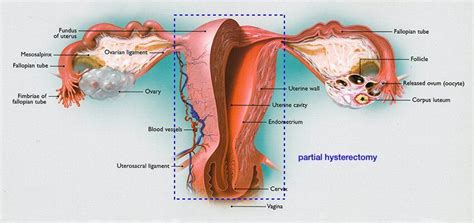 Hysterectomy The Center For Innovative Gyn Care