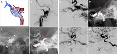 Embolization Of A Traumatic Carotid Cavernous Fistula With The Surpass