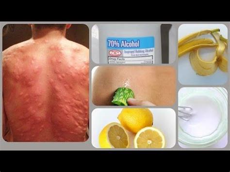 Mosquito bites are a common occurrence that can cause inflammation and itching. Make Mosquito Bites Stop Itching With These 10 Weird ...