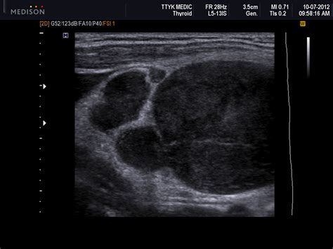 Vietnamese Medic Ultrasound Case 131 Left Supraclavicular Nodes