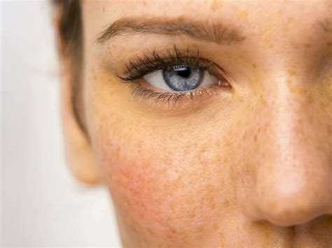 Hyperpigmentation • Aetherclinic