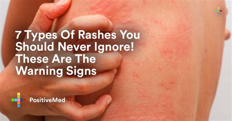 Types Of Rashes You Should Never Ignore These Are The Warning Signs