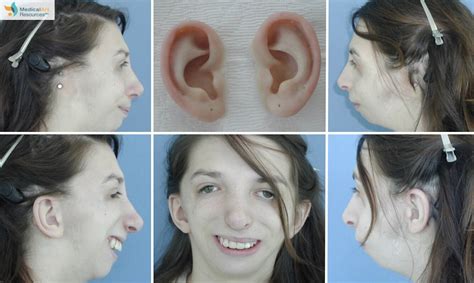 Ear Prosthesis Photos Medical Art Resources — Life Like Prosthetics
