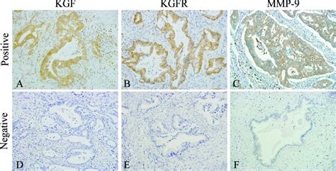 Immunohistochemical Analysis Of Kgf Kgfr And Mmp In Pancreatic