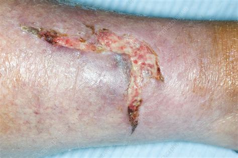 Flap laceration of the leg - Stock Image - C004/1292 - Science Photo ...