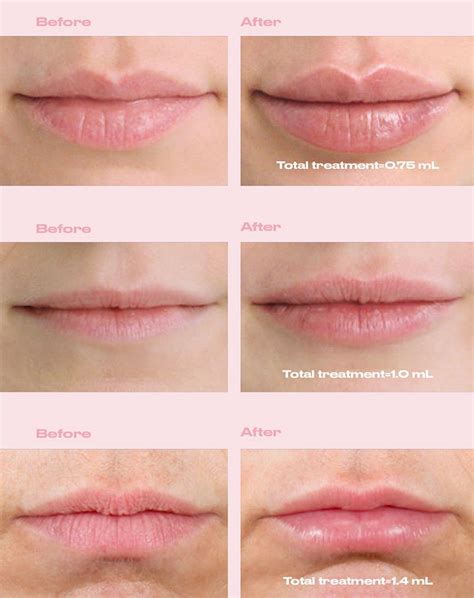Restylane Kysse Improves Volume And Texture Of Lips Your Great Skin