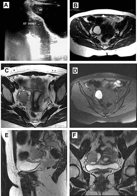 A Relatively Hyperechoic Sol At Right Ovary B Mri Axial T1wi Shows