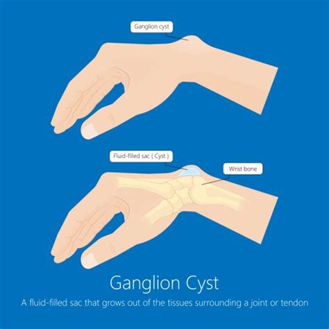 Ganglion Cysts Sydney Orthopaedic Surgeon