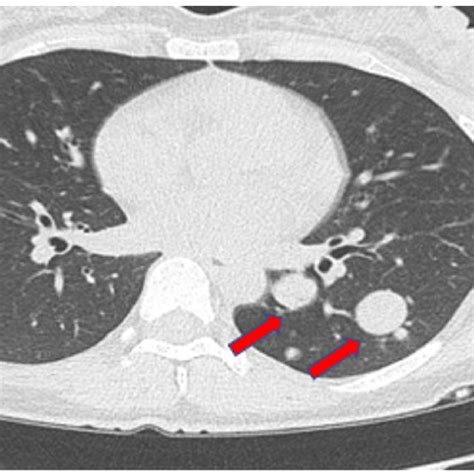 Chest Ct Showed Multiple Approximately 49 Nodules And A Maximal 28