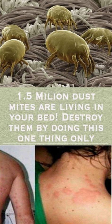 Amazing What Mites Can Live On Humans Insectza