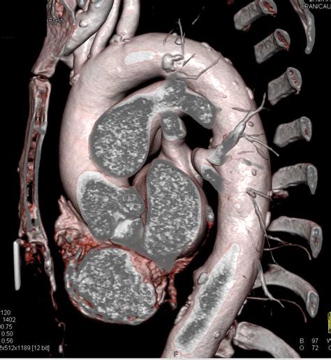 Ulcerating Plaque In Descending Thoracic Aorta Vascular Case Studies