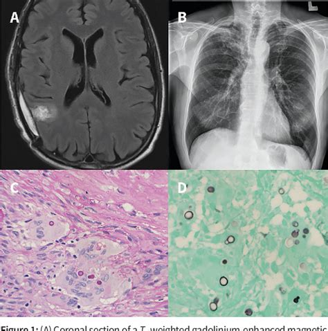 Figure 1 From Disseminated Blastomycosis In A 57 Year Old Man Working In Construction Semantic