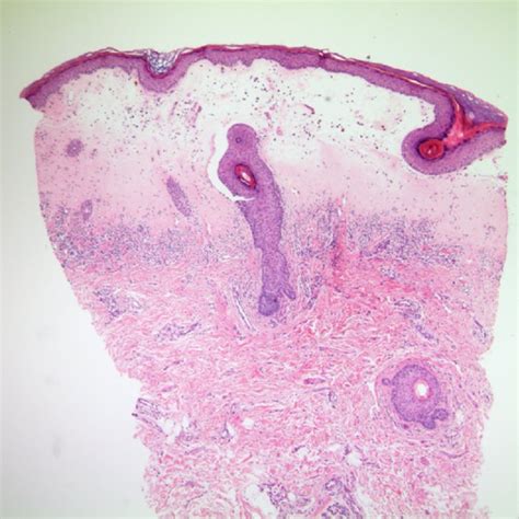 Rebiopsy Specimen From The Eroded Patch Of The Labia Minora Shows Download Scientific Diagram