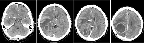 Cerebral Abscess Radiology Cases
