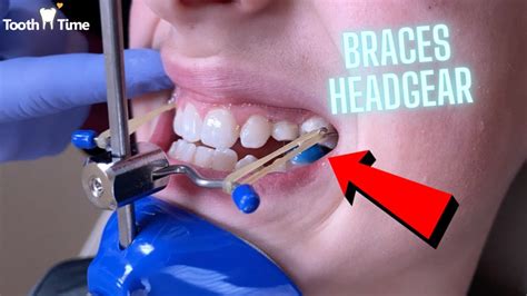 Headgear Braces Orthodontic Appliance Year Old Patient Tooth Time New Braunfels Texas
