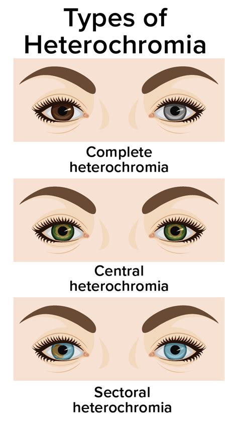 Types Of Heterochromia