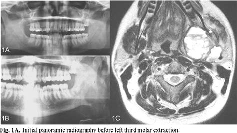 Figure 1 From Giant Aneurysmal Bone Cyst Of The Mandible With Unusual