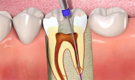 Tratamiento Del Nervio Dental Clínica Trei