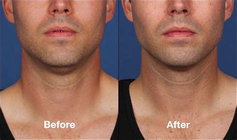 Kybella For Double Chin Tribeca Skin Center Nyc Downtown Manhattan