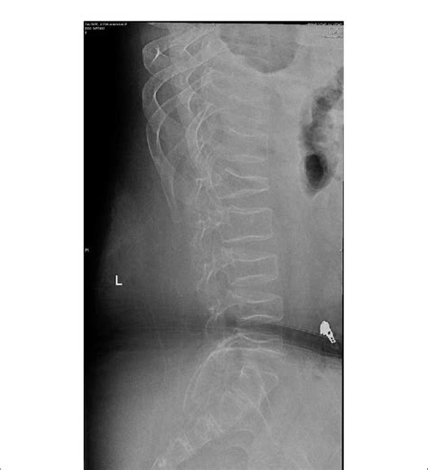 Radiograph Showing Compression Fractures Of L1 L3 L4 And Mild