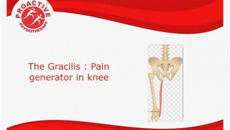 The Gracilis Pain Generator In Knee Proactive Physio Knowledge