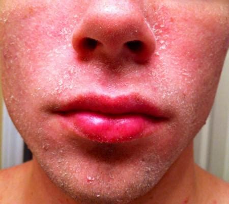 We've been picking zucchini for weeks, and it seems that every time we go outside there's another zucchini on the plant just waiting to be picked. Dillon's Log - The Acne.org Regimen logs - by Dillon S ...