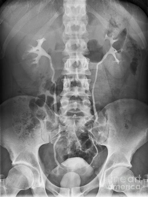 Healthy Urinary Tract X Ray Photograph By Science Photo Library