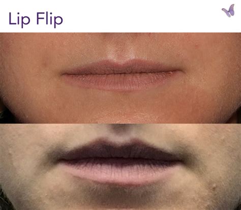 How Lasers Treat Smokers Lines Above Your Upper Lip Derma Health