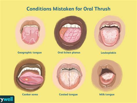 Oral Thrush Pictures Shop Save Jlcatj Gob Mx